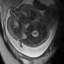 Axial T2w Fetal MRI