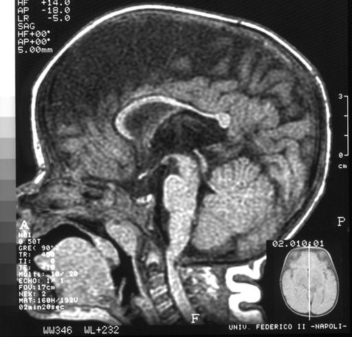 Pediaric MRI