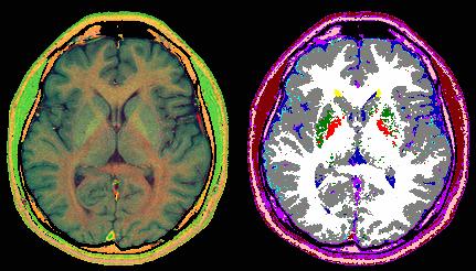 MRI Segmentation