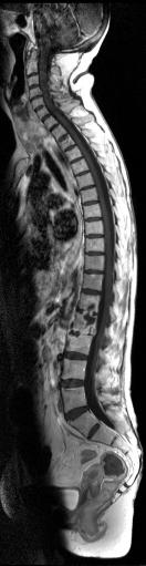 Spine MRI