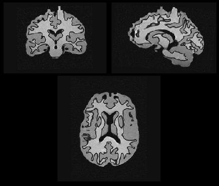 MRI of StepBrain